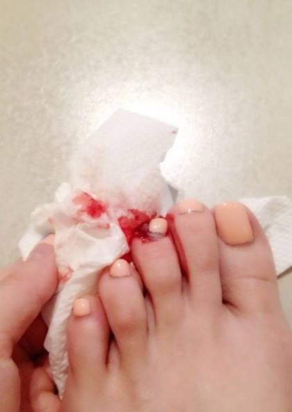 What Do Toe bleeding Symbolize in Dreams and How to Interpret the Meaning