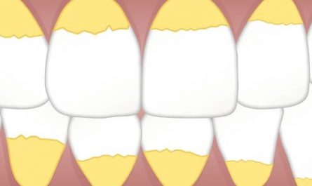 8 Symbolic Meanings of Dreams about Dental Plaque