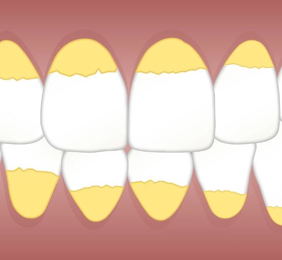 8 Symbolic Meanings of Dreams about Dental Plaque